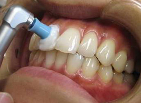 予防歯科・メンテナンスについて